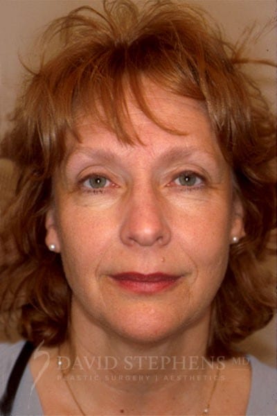 Facelift-Patient-01 | Before Facelift