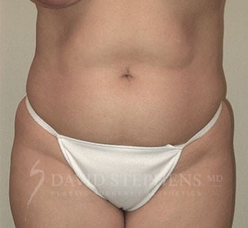Abdominoplasty-Patient-01 | Before Abdominoplasty