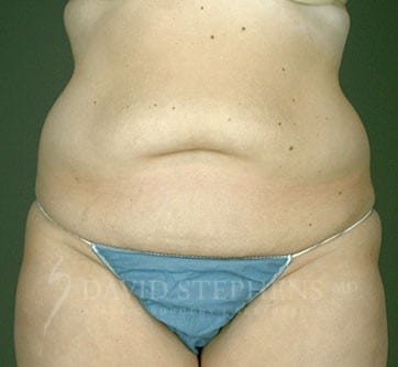 Abdominoplasty-Patient-03 | Before Abdominoplasty