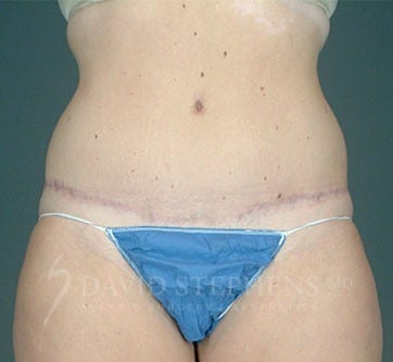 Abdominoplasty-Patient-03 | After Abdominoplasty