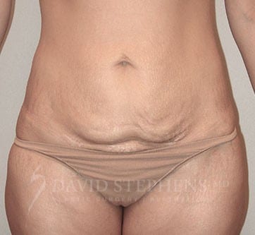 Abdominoplasty-Patient-05 | Before Abdominoplasty