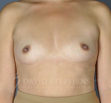 Breast-Augmentation-Patient-04 | Before Breast Augmentation