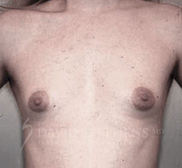 Breast-Augmentation-Patient-07 | Before Breast Augmentation