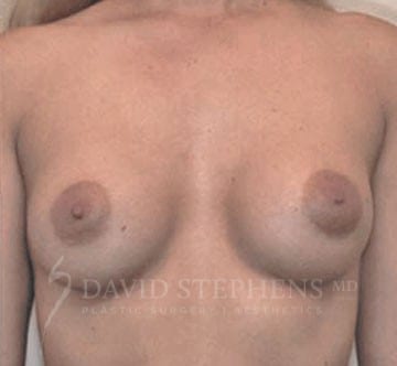 Breast-Augmentation-Patient-07 | After Breast Augmentation