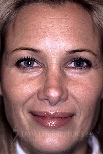 Browlift-Patient-01 | Before Browlift