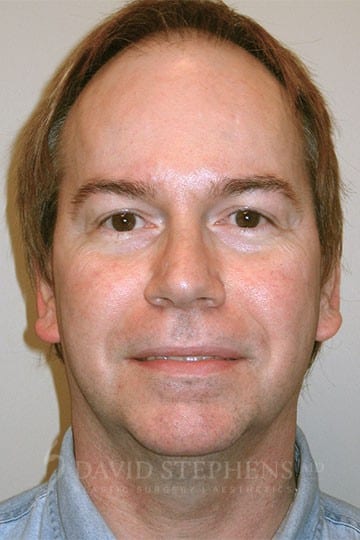 Facelift-Patient-03 | Before Face Lift