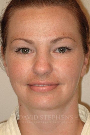 Neck-Liposuction-Patient-01 | After Neck/Chin Liposuction