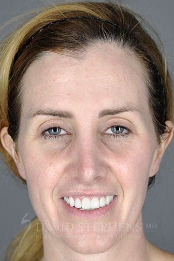 Rhinoplasty-Patient-02 | After Rhinoplasty