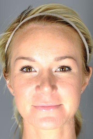 Rhinoplasty-Patient-04 | After Rhinoplasty