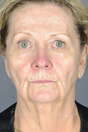 Face-Lift-Patient-04 | Before Facelift