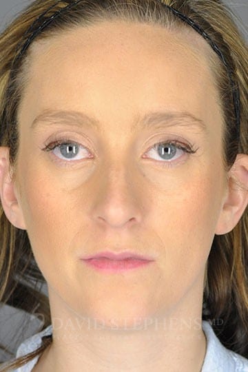 Rhinoplasty Before 5