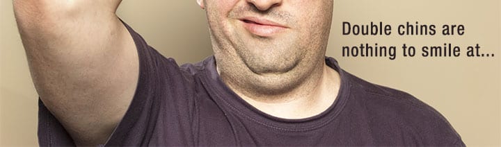 double-chin-kybella