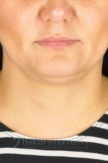 Kybella-Patient-01 | Before Kybella