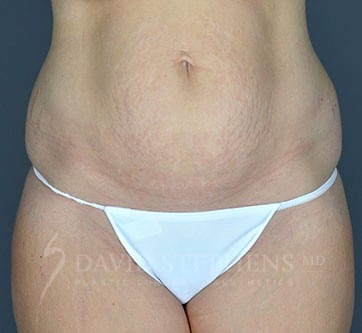 Abdominoplasty-Patient-06 | Before Abdominoplasty