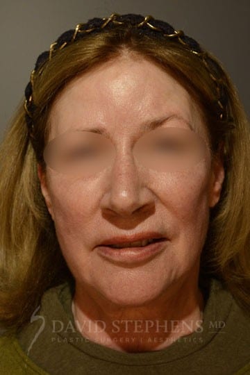 Facelift-Patient-05 | Before Facelift