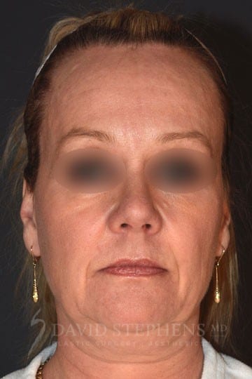 Facelift-Patient-08 | Before Facelift