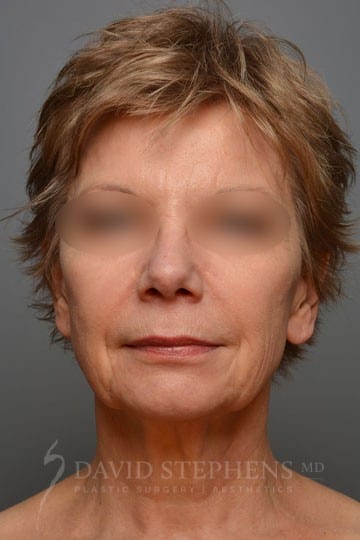 Facelift-Patient-09 | Before Facelift