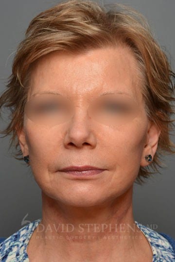 Facelift-Patient-09 | After Facelift