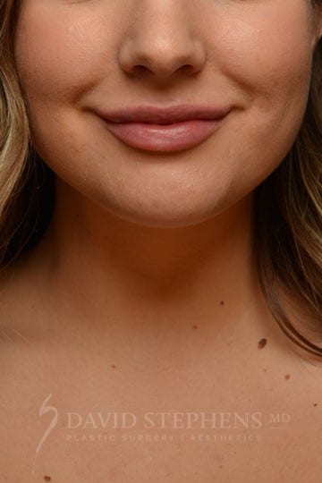 Juvederm-Ultra-XC-Results-1 | After Botox & Fillers