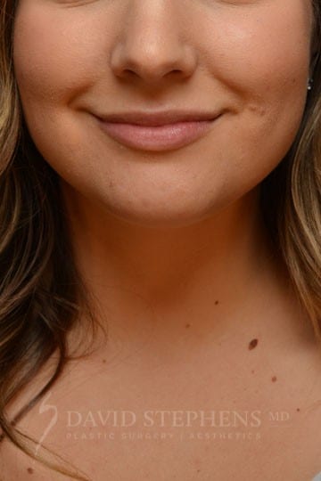 Juvederm-Ultra-XC-Results-1 | Before Botox & Fillers