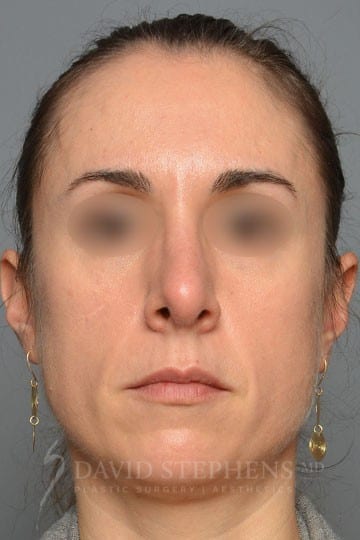 Rhinoplasty-Patient-07 | After Rhinoplasty