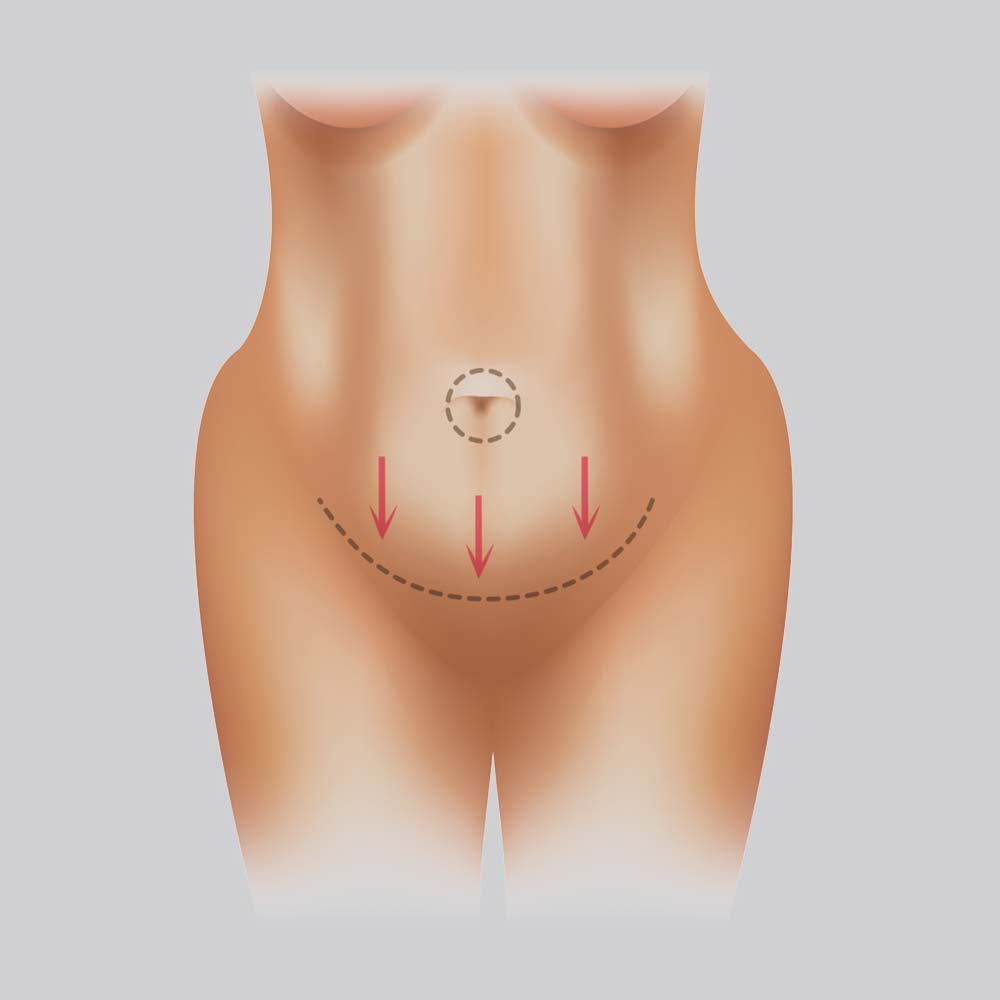 Illustration - Tummy Tuck