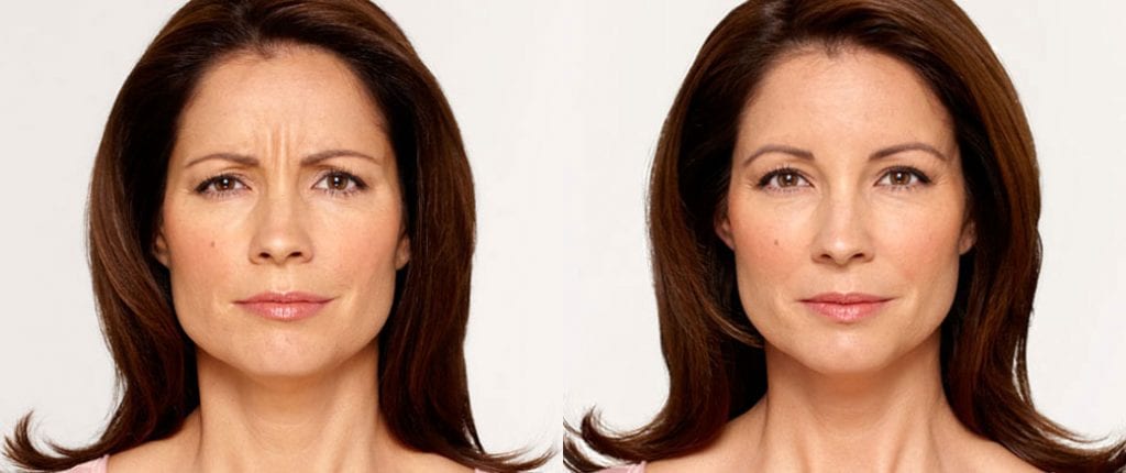 Before and after, Image courtesy of BOTOX® Cosmetic
