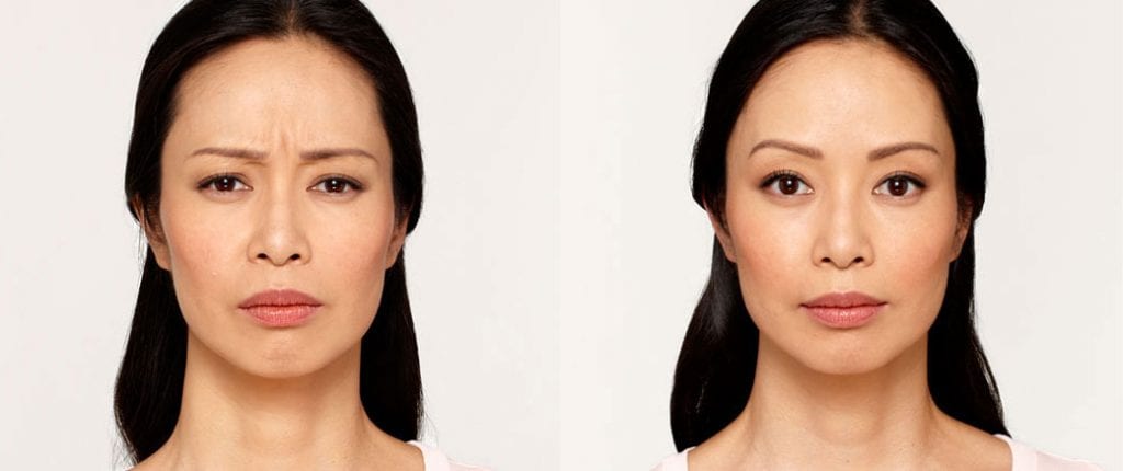 Before and after, Image courtesy of BOTOX® Cosmetic