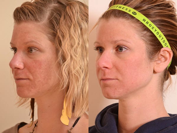 Before and After Halo Treatment