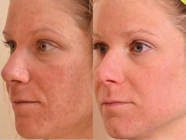 Before and after Halo treatment