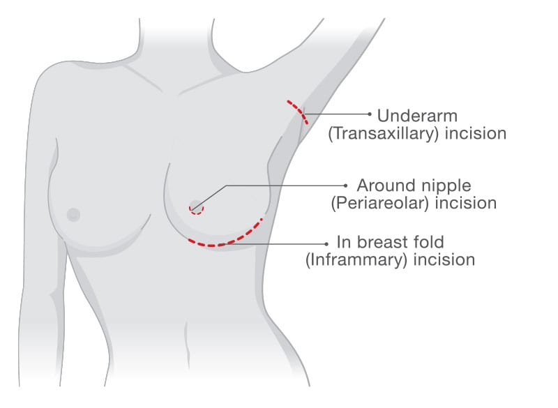 Diagram: Implant Placement