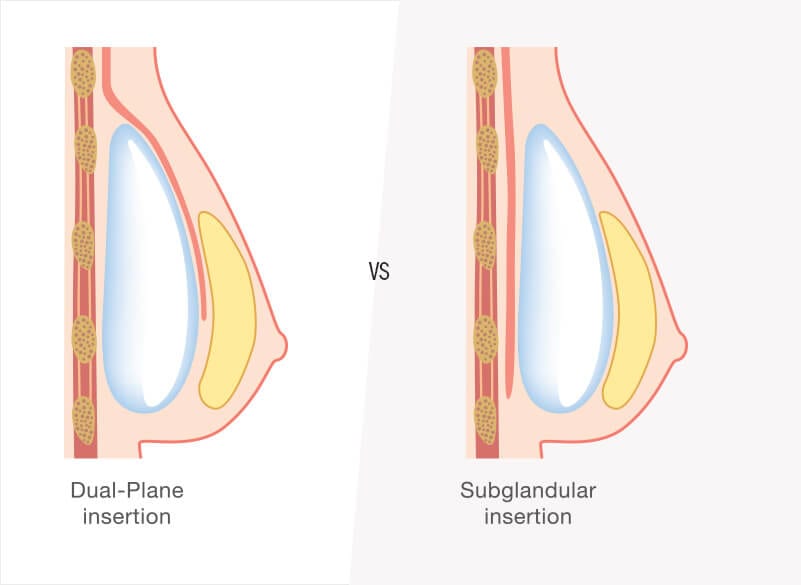 Diagram: Dual Plane vs Subglandular insertion