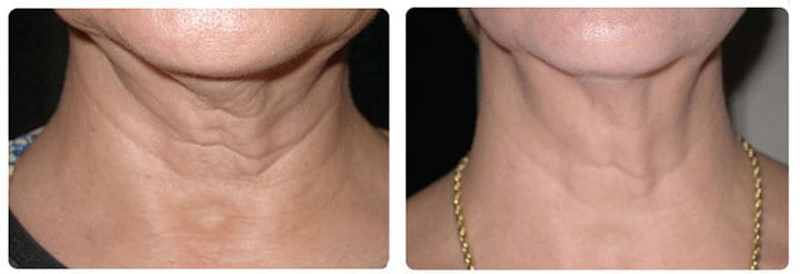 Before and after SkinTite procedure