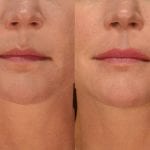 Before and after results of woman with fuller lips