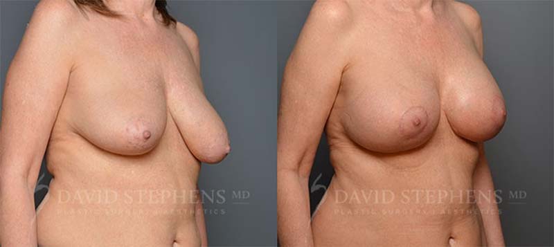 Before and after - Breast augmentation with lift
