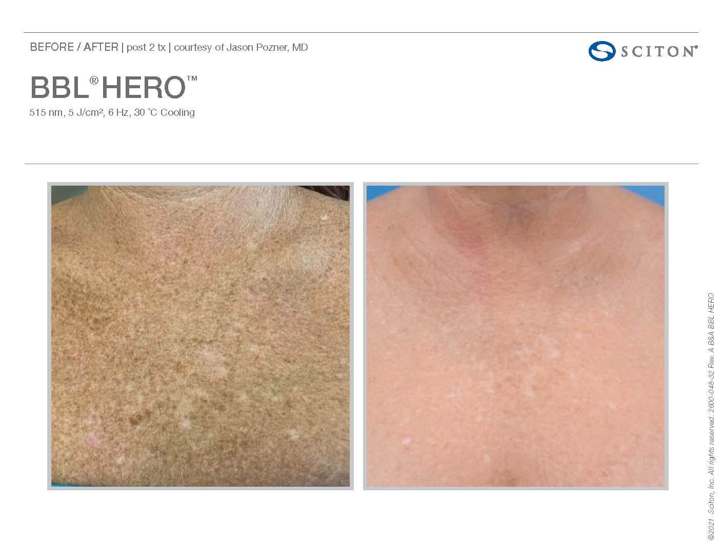 Before and after BBL Hero on Chest - Patient 2