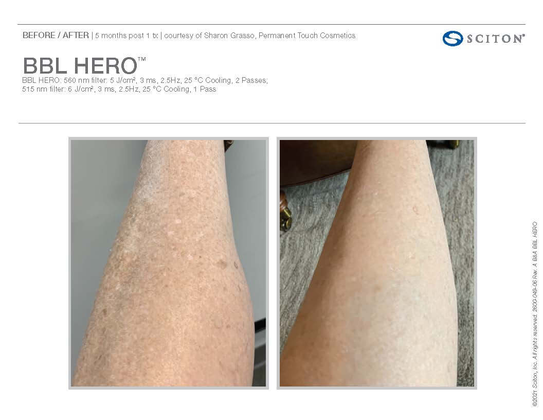 Before and after BBL Hero on leg