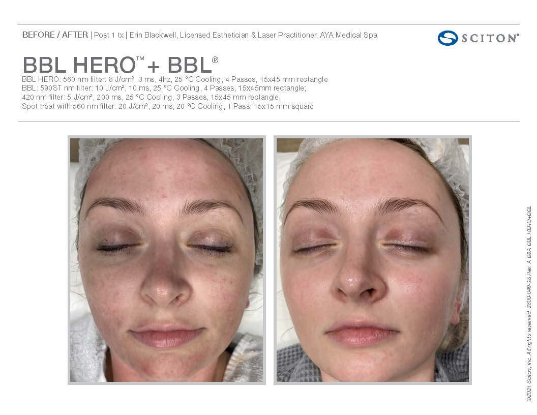 Before and after BBL Hero on face