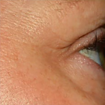 ALASTIN Skincare® - Actual Patient Results - After - 1