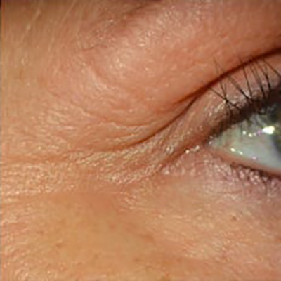 ALASTIN Skincare® - Actual Patient Results - Before - 1