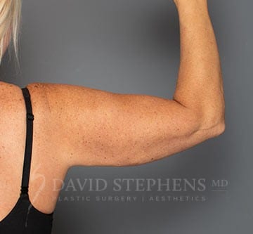 BodyTite® Assisted Body Contouring - Actual Patient Results - After - 2