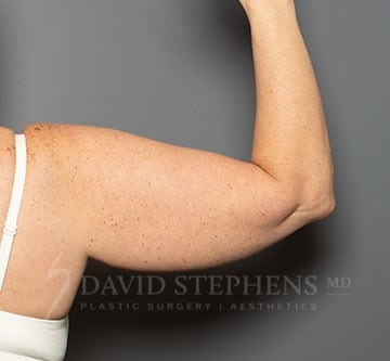 BodyTite® Assisted Body Contouring - Actual Patient Results - Before - 2