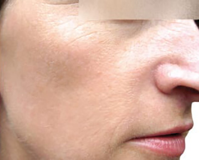 Forever Young BBL™ Photo Facial - Actual Patient Results - After - 2