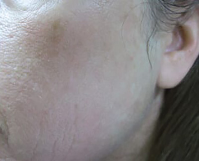 Forever Young BBL™ Photo Facial - Actual Patient Results - After - 3