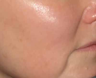Forever Young BBL™ Photo Facial - Actual Patient Results - After - 4
