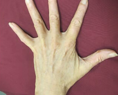 Forever Young BBL™ Photo Facial - Actual Patient Results - After - 5