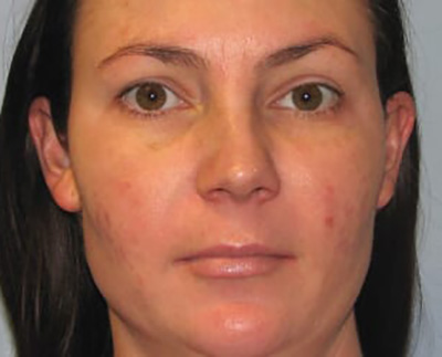 Forever Young BBL™ Photo Facial - Actual Patient Results - After - 6