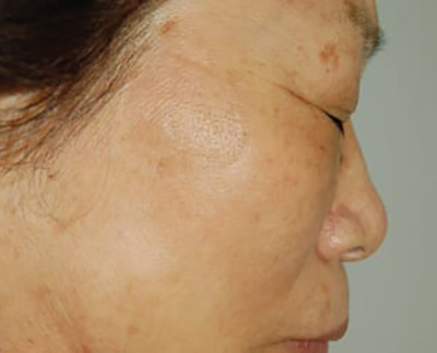 Forever Young BBL™ Photo Facial - Actual Patient Results - After - 7
