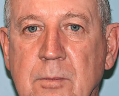 Forever Young BBL™ Photo Facial - Actual Patient Results - After - 8