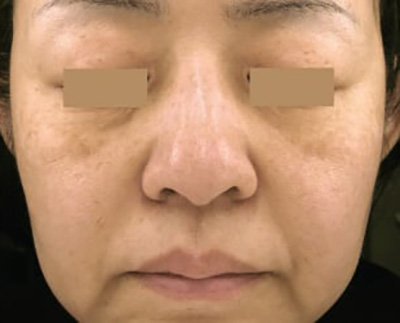 Forever Young BBL™ Photo Facial - Actual Patient Results - After - 9